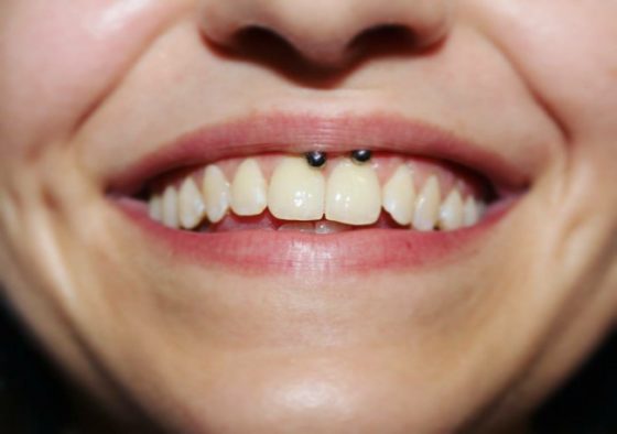 Smiley Piercing [50 Ideas]: Pain Level, Healing Time, Cost, Experience ...