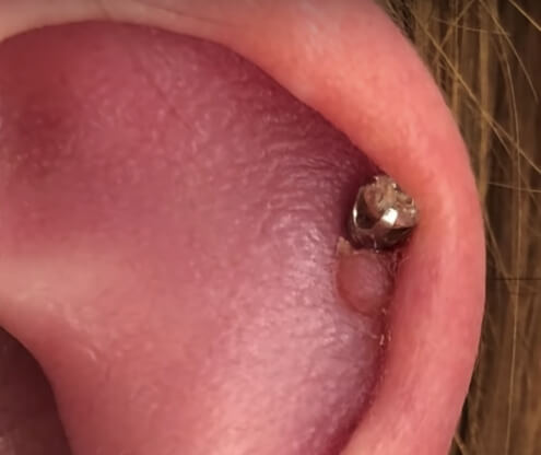 Piercing Bump 6 Ways To Get Rid Of Cartilage Or Nose Keloid Blister