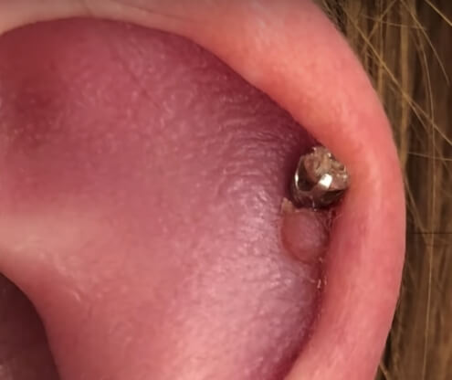 rook piercing keloid