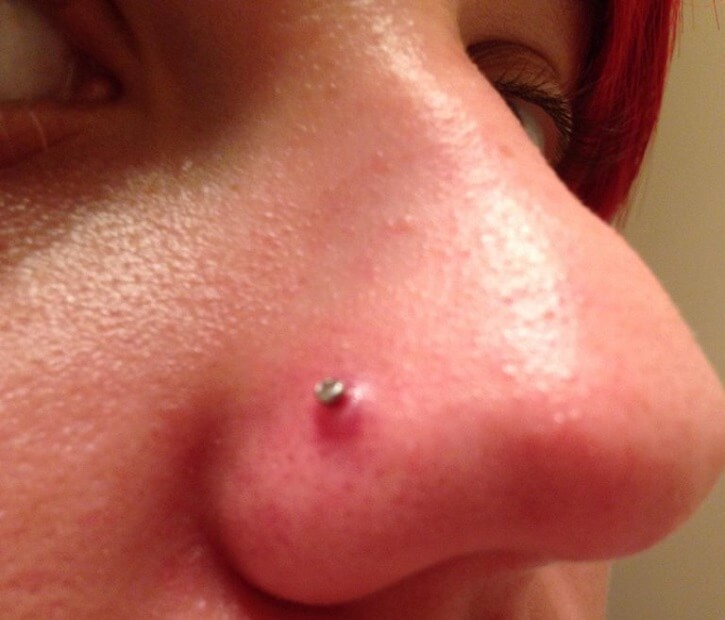Piercing Infection 4 Ways To Heal Fast Infected Ear Nose Piercing