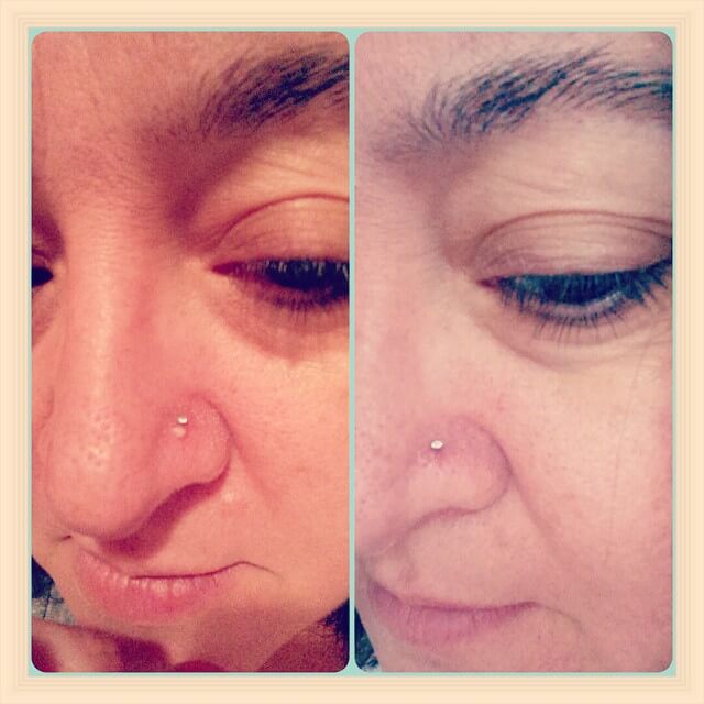 nose piercing bump before and after