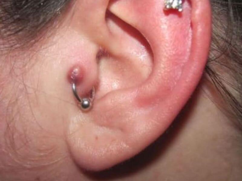 What to do hot sale if earring gets infected