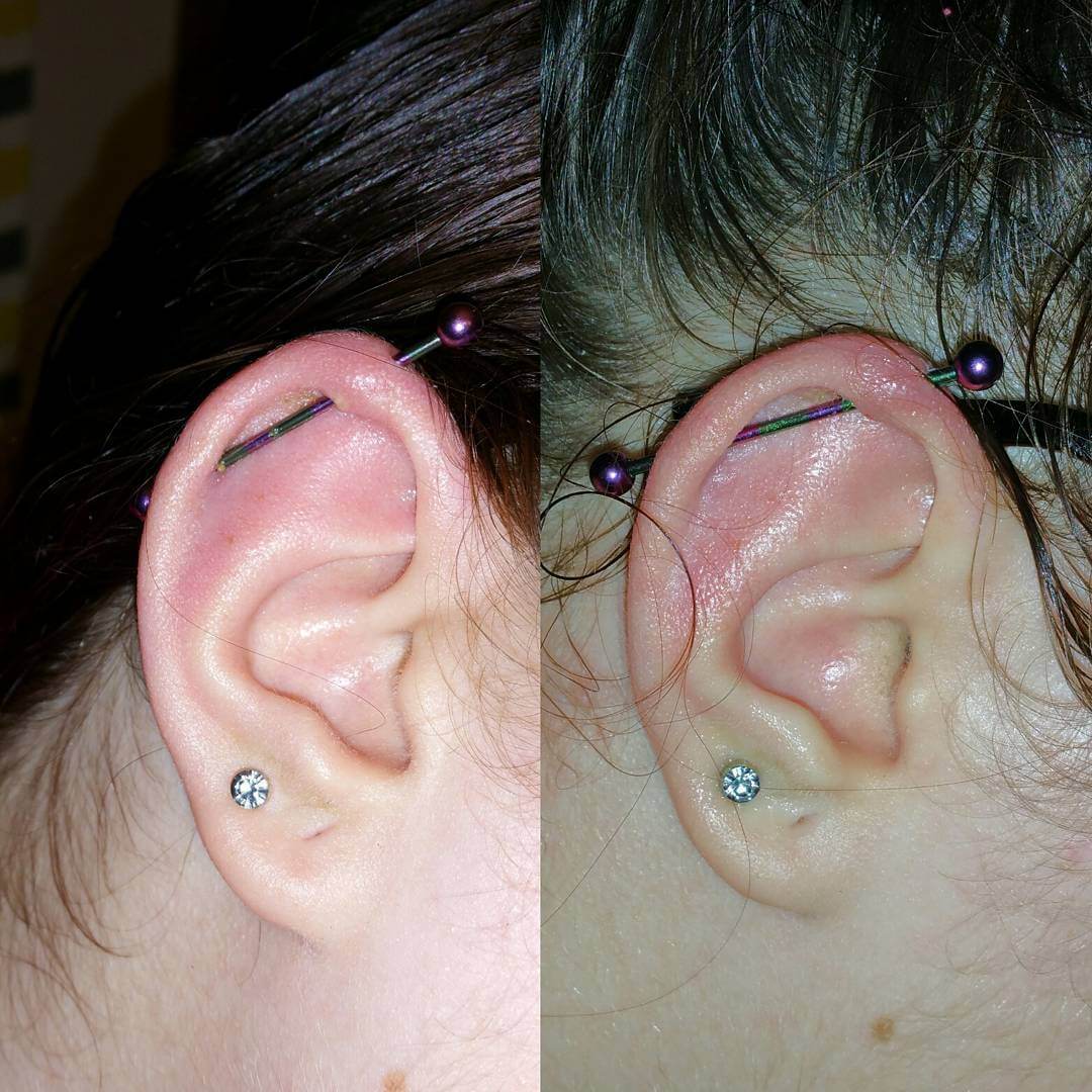 infected cartilage piercing