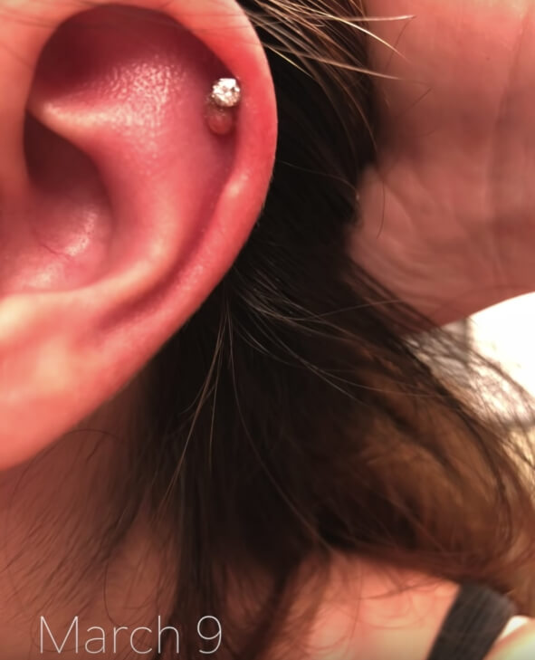 helix bump around piercing