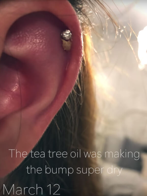 bump on ear piercing