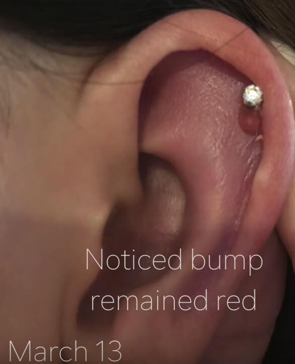 bubble on cartilage piercing