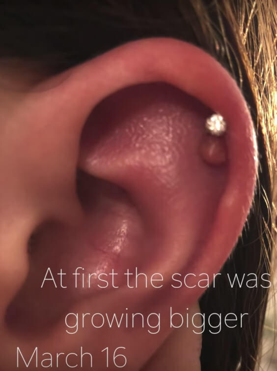 helix piercing hard bump