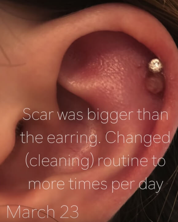 lump on cartilage piercing