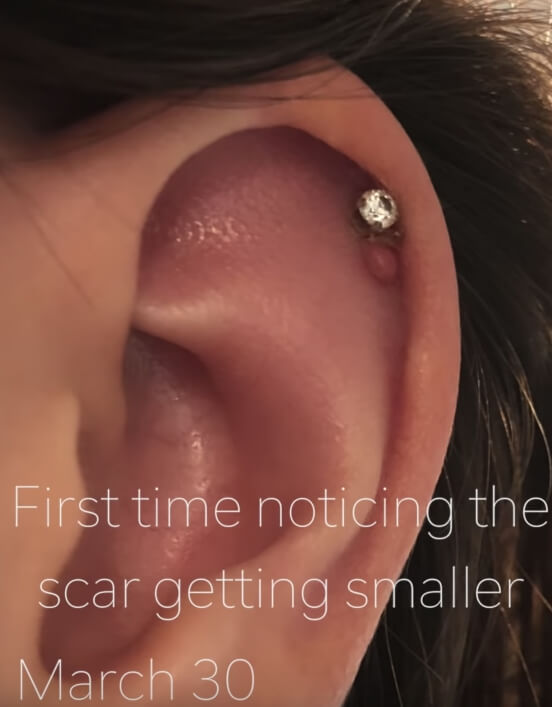 pustule bump on cartilage piercing next to jewelry