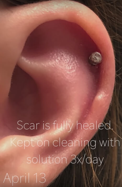 volledig genezen piercing keloid foto