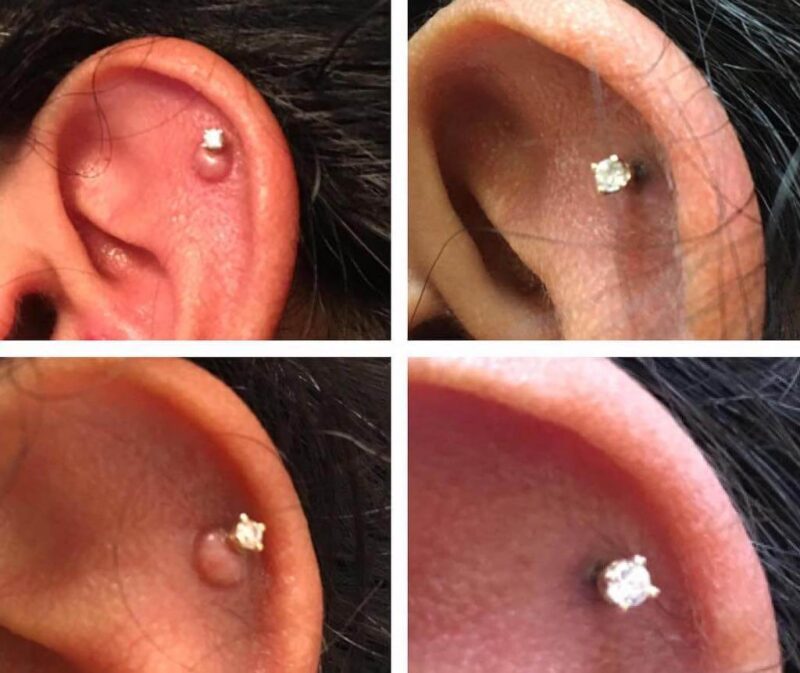 Piercing Bump: 6 Ways to GET RID of Cartilage or Nose ...
