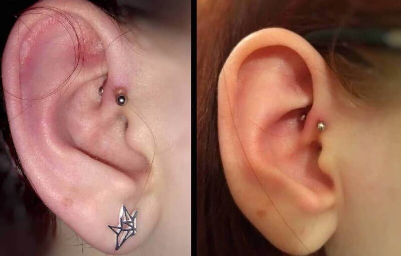 helix ear piercing lump